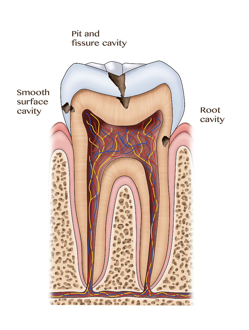 Types of Dental Cavities, Illustration