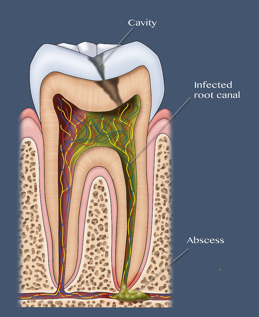 Dental Cavity and Abscess, Illustration
