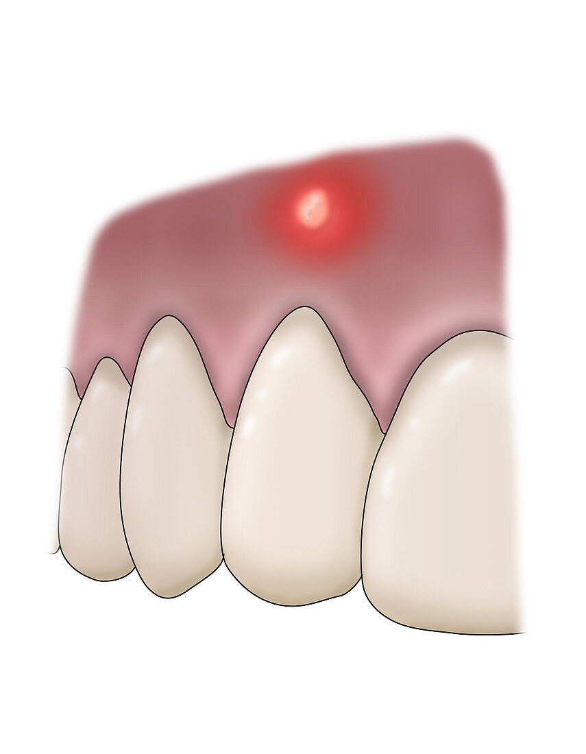 Periapical Abscess, Illustration