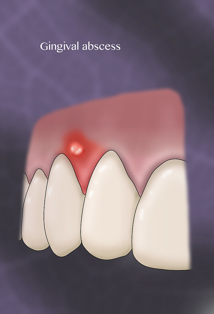 Gingival Abscess, Illustration