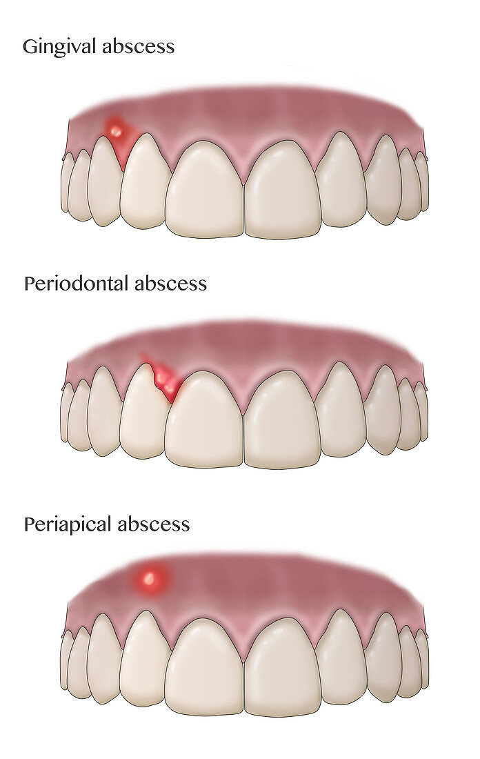 Types of Dental Abscesses, Illustration