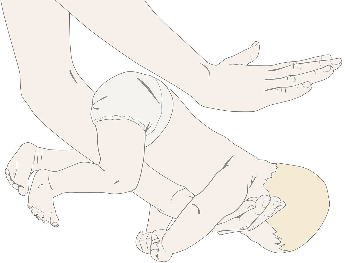 Heimlich manoeuvre on newborn, illustration