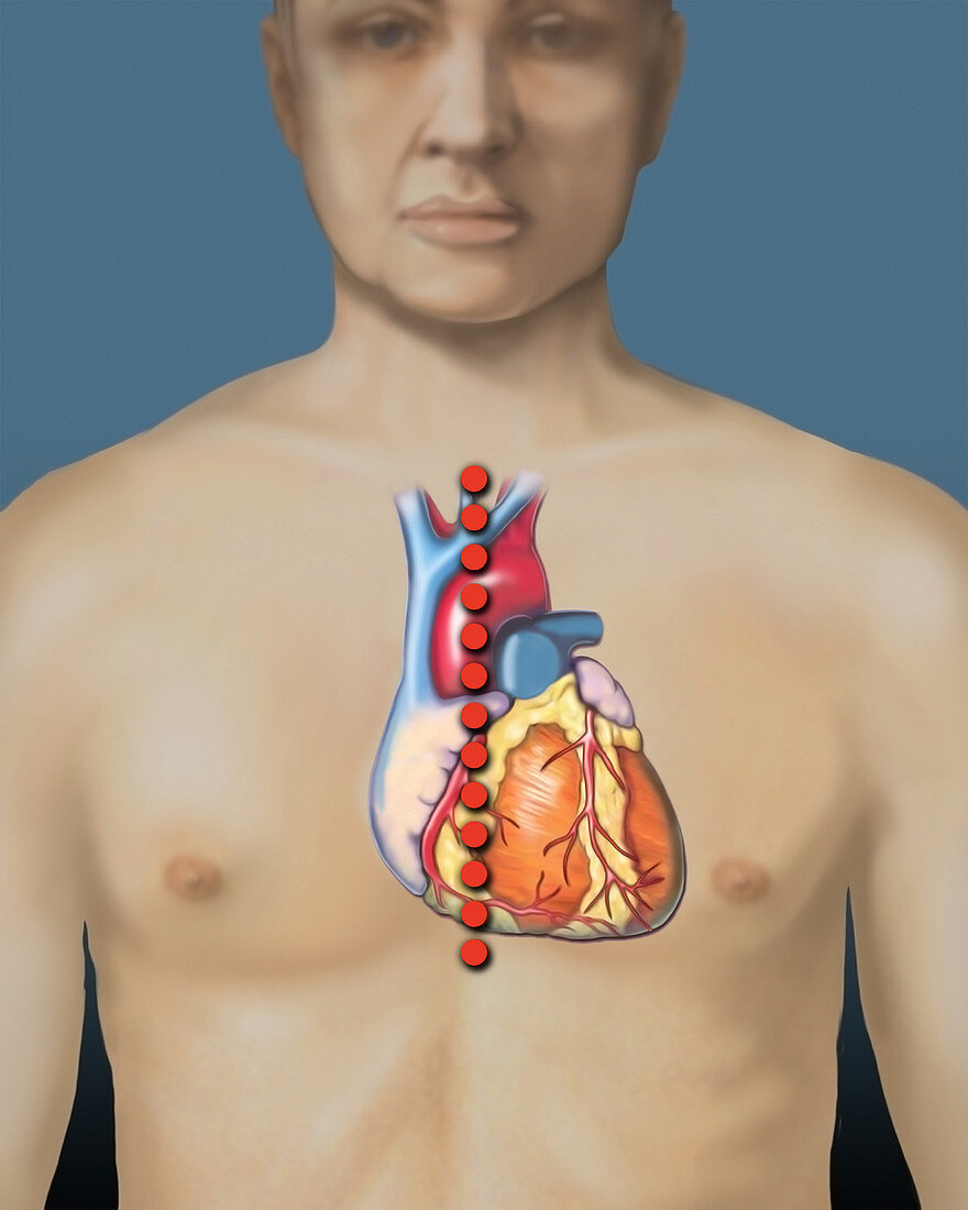 Heart transplant, median sternotomy, illustration
