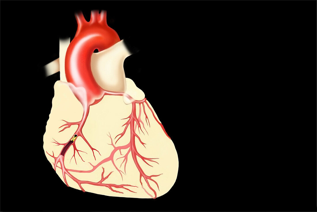 Coronary artery disease, illustration