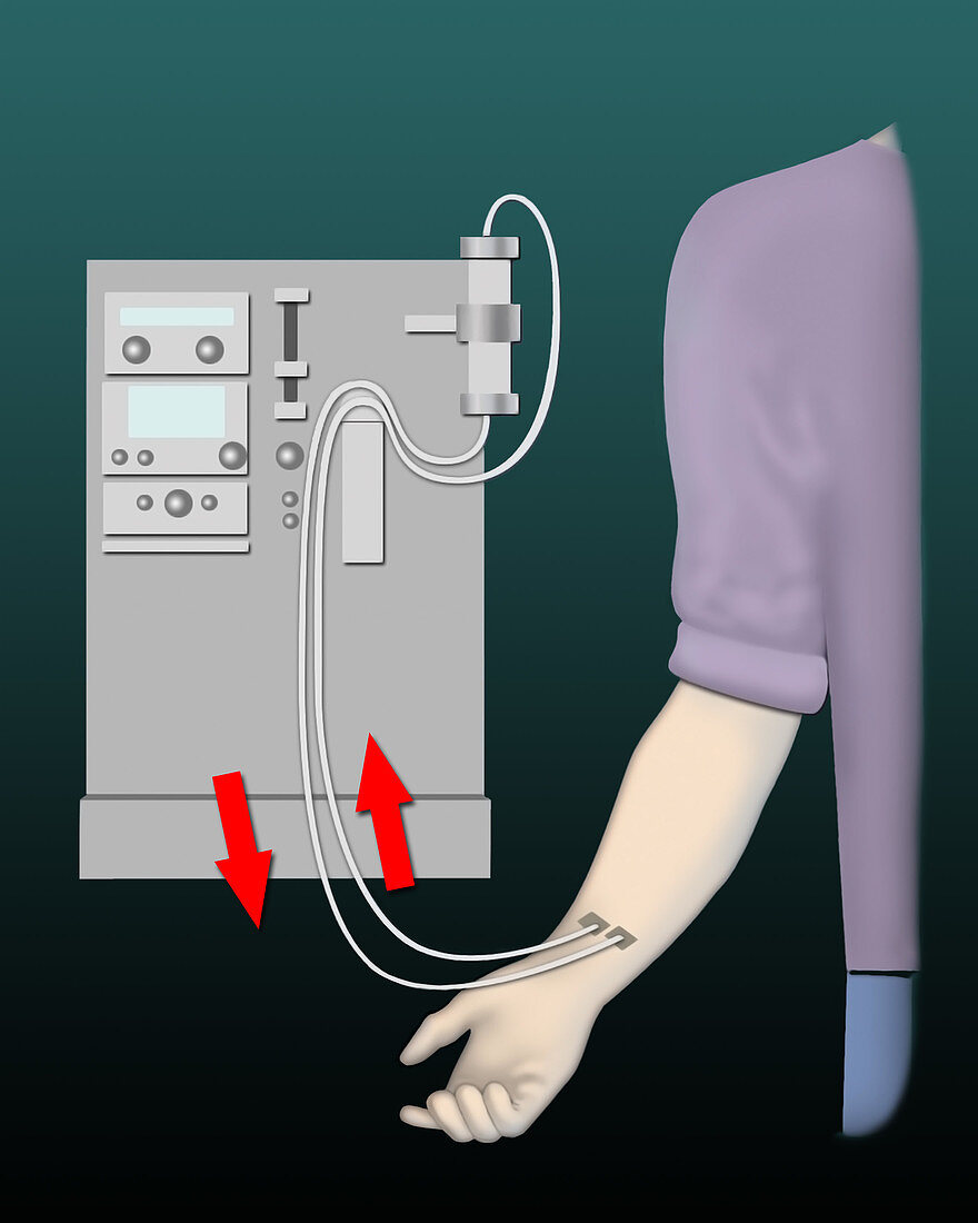 Dialysis, illustration
