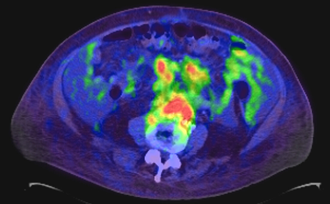Abdominal adenopathy, CT scan