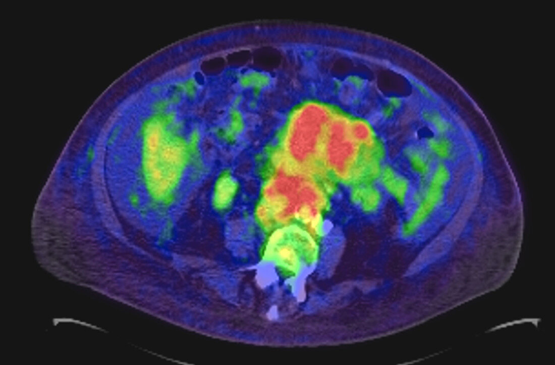 Abdominal adenopathy, PET-CT scan