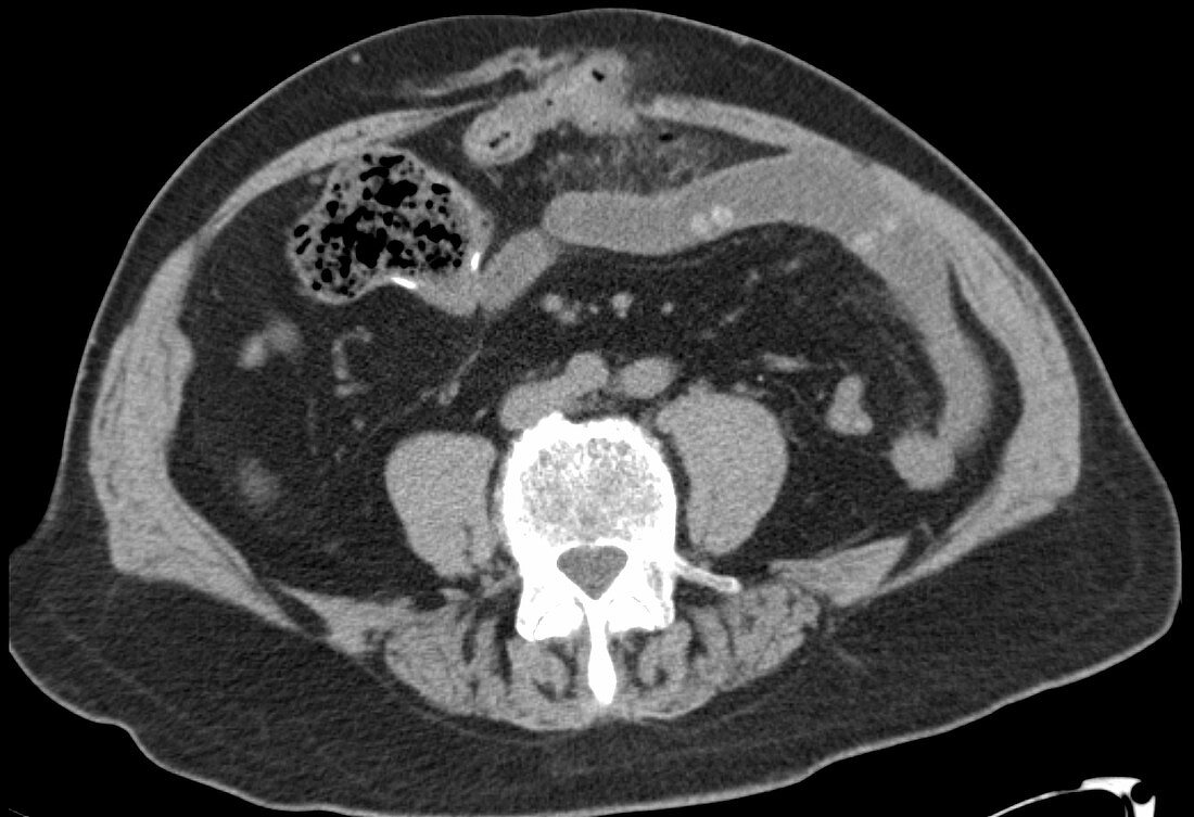 Colon perforation, CT scan