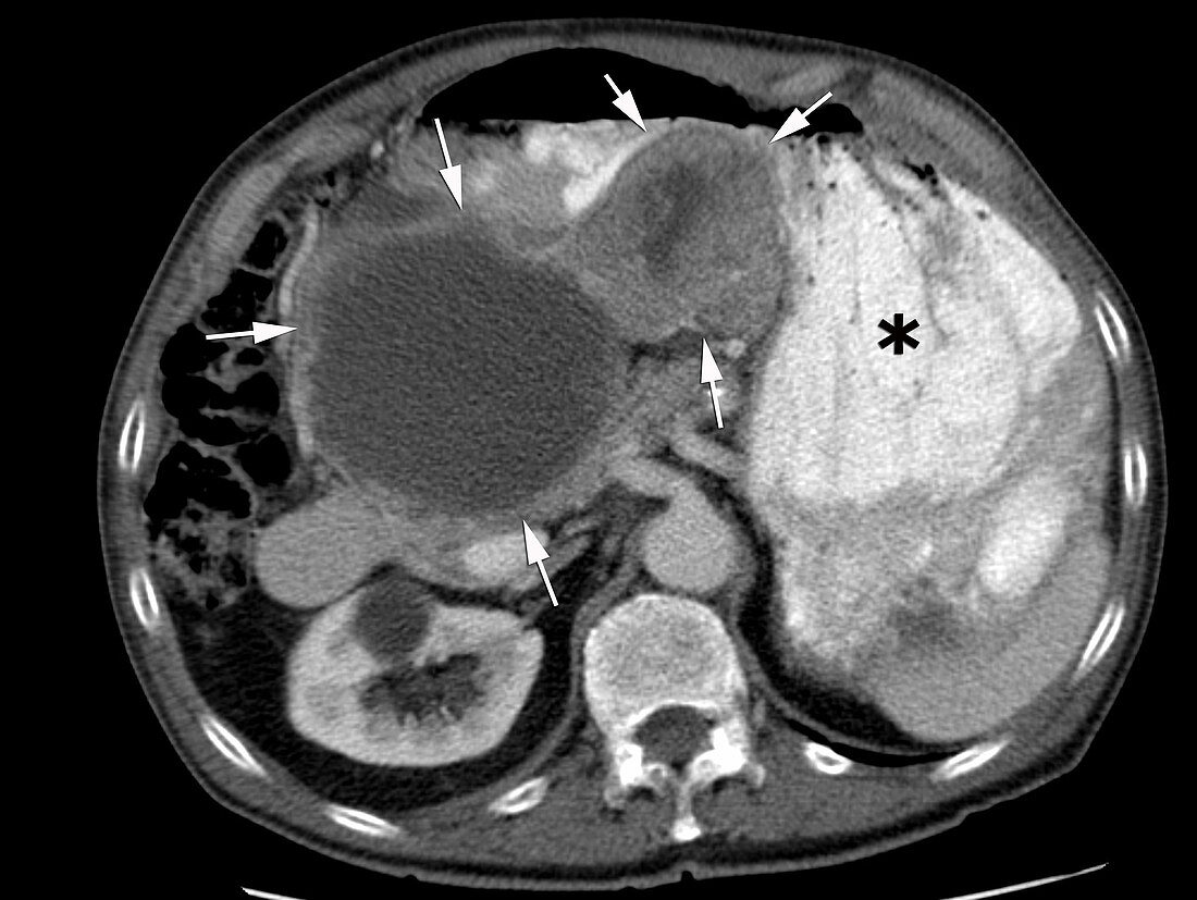 Gastrointestinal stromal tumour, CT scan
