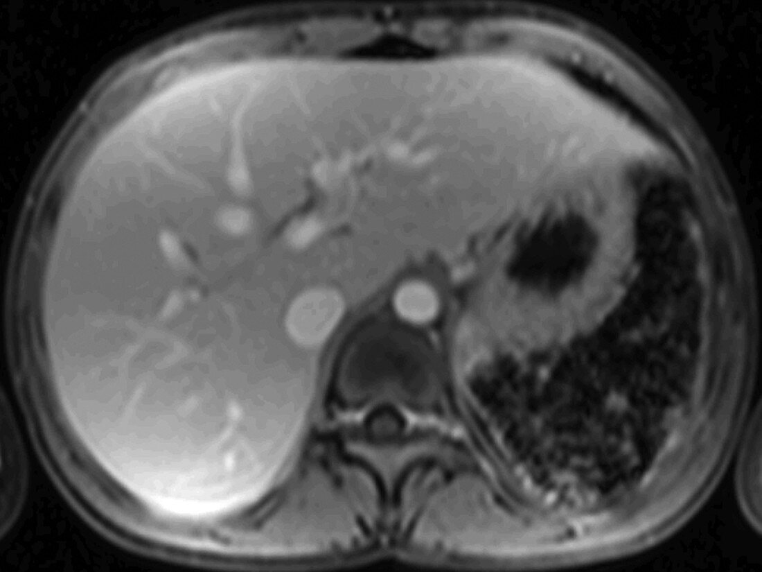 Hemochromatosis, MRI