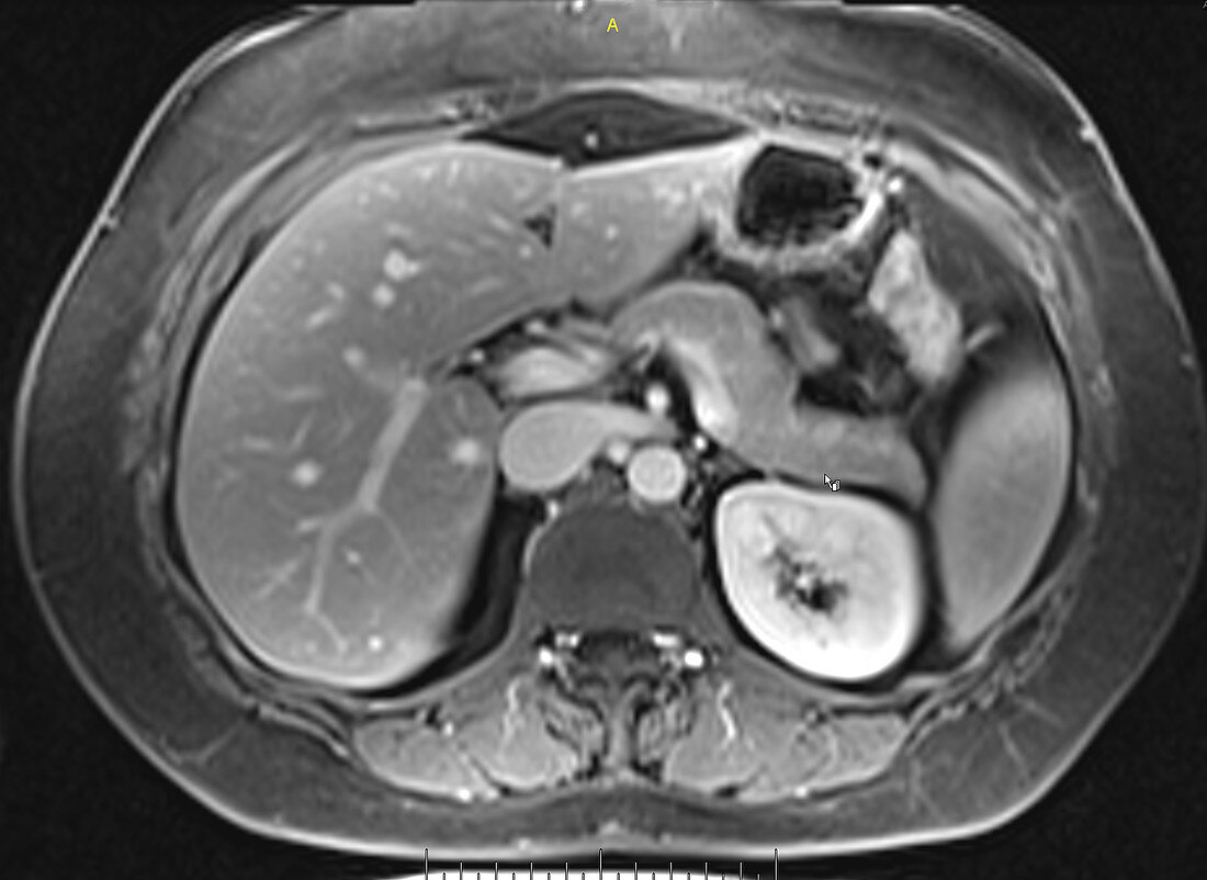 Normal pancreas, MRI
