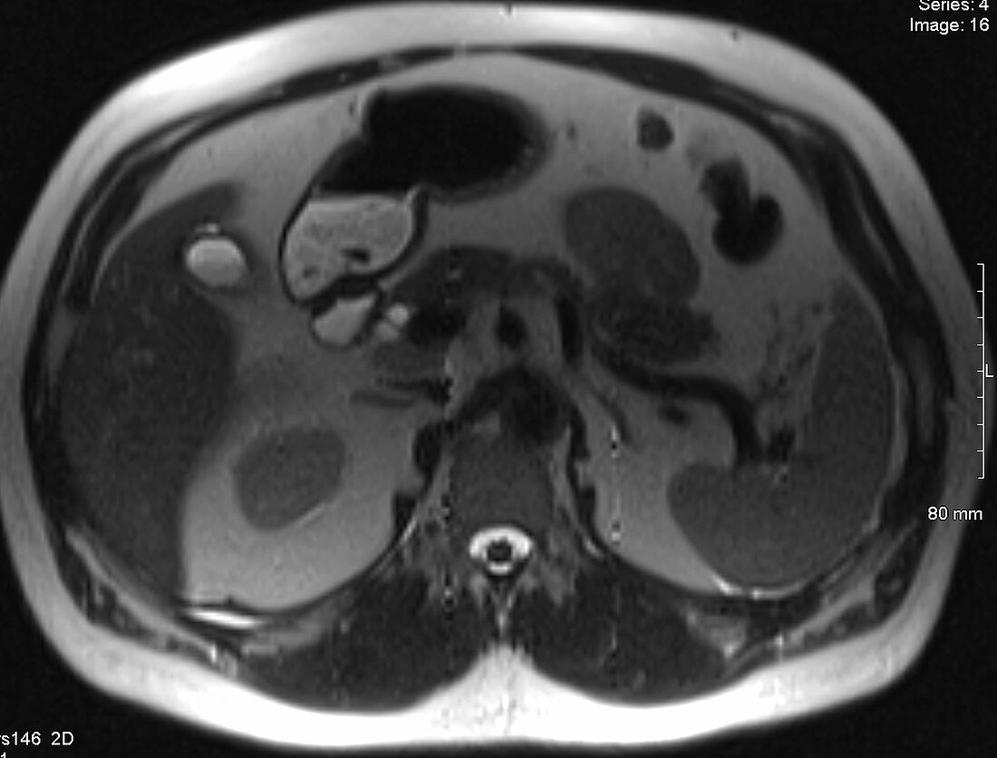 Normal spleen, MRI