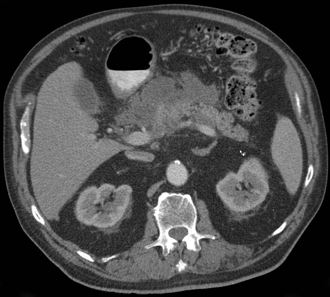 Pancreatitis, CT scan
