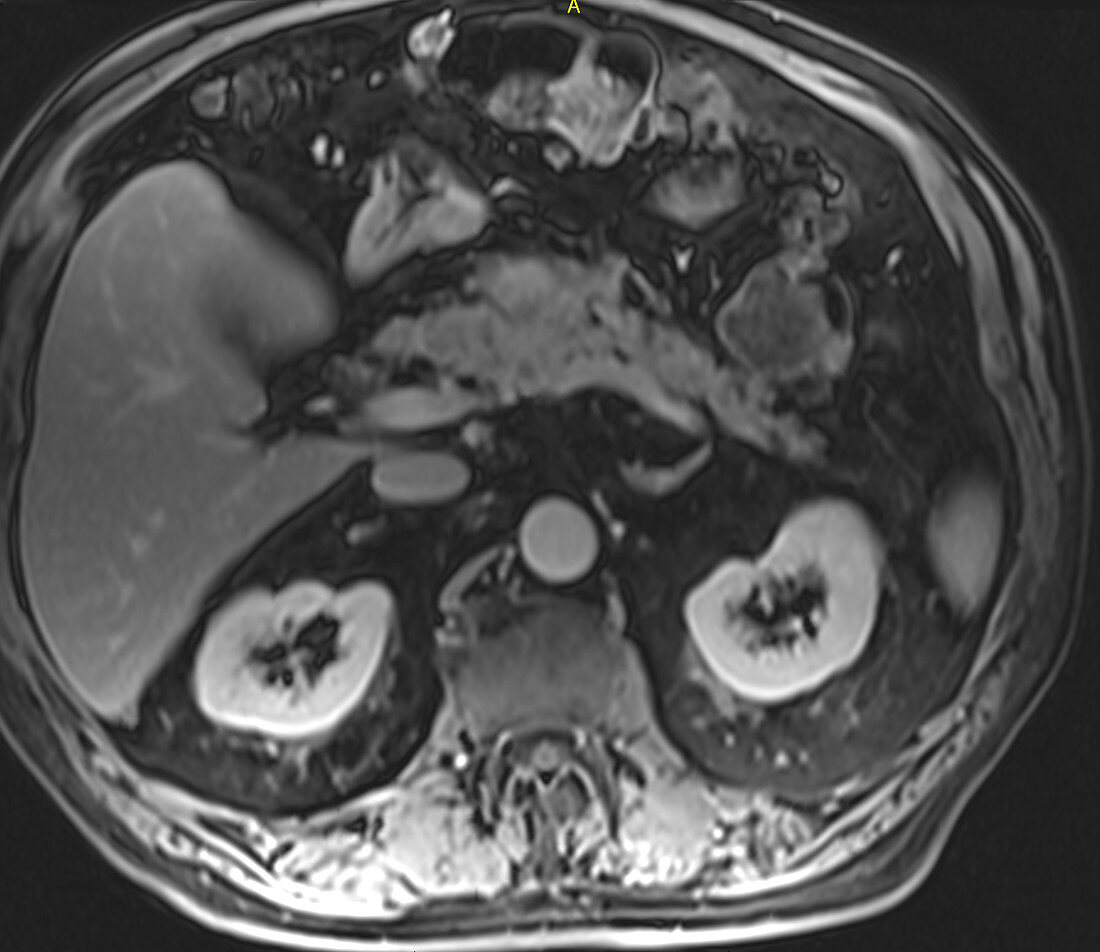Pancreatitis, MRI