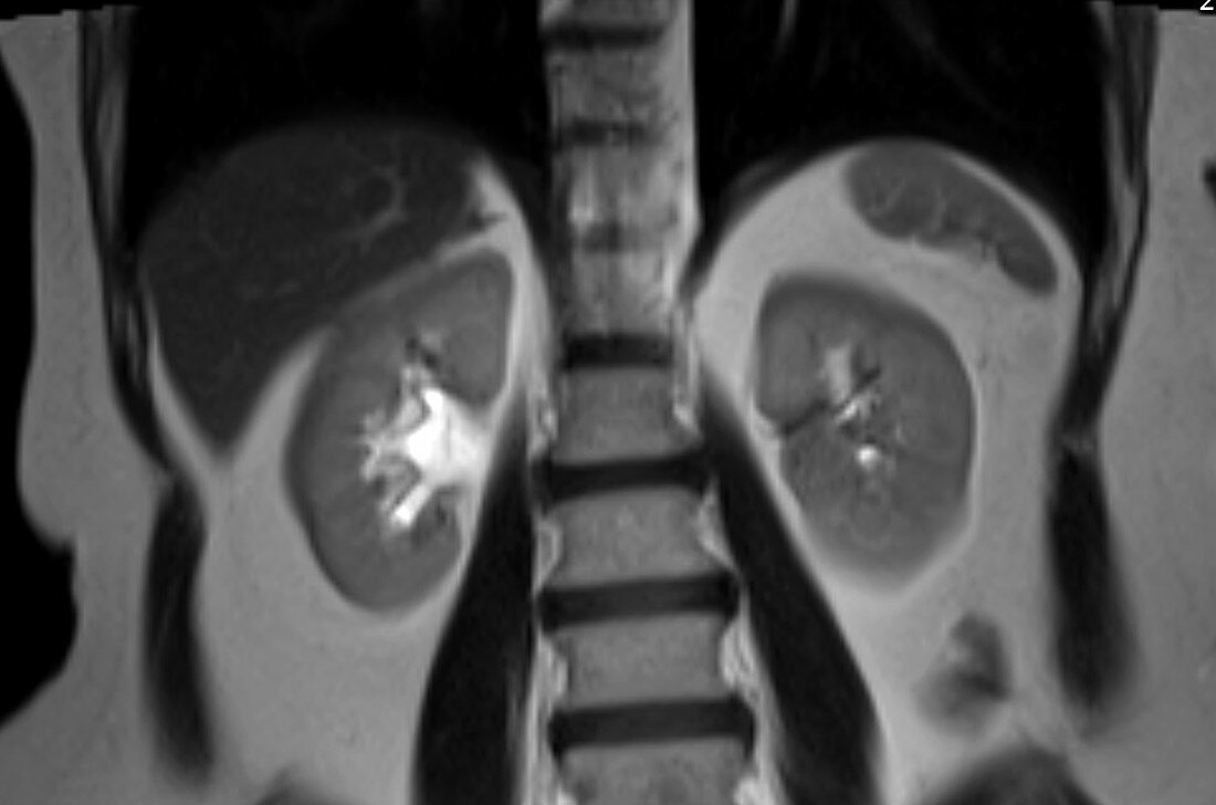 Small spleen, MRI