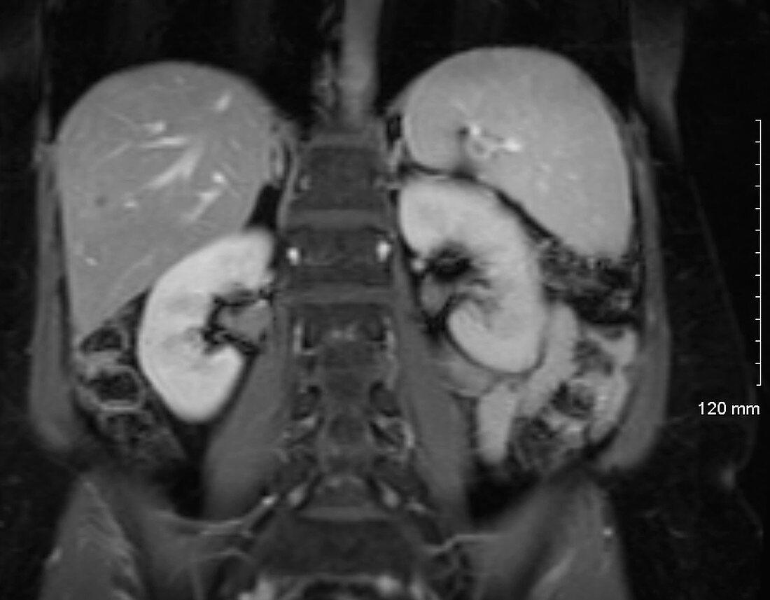 Enlarged spleen, MRI