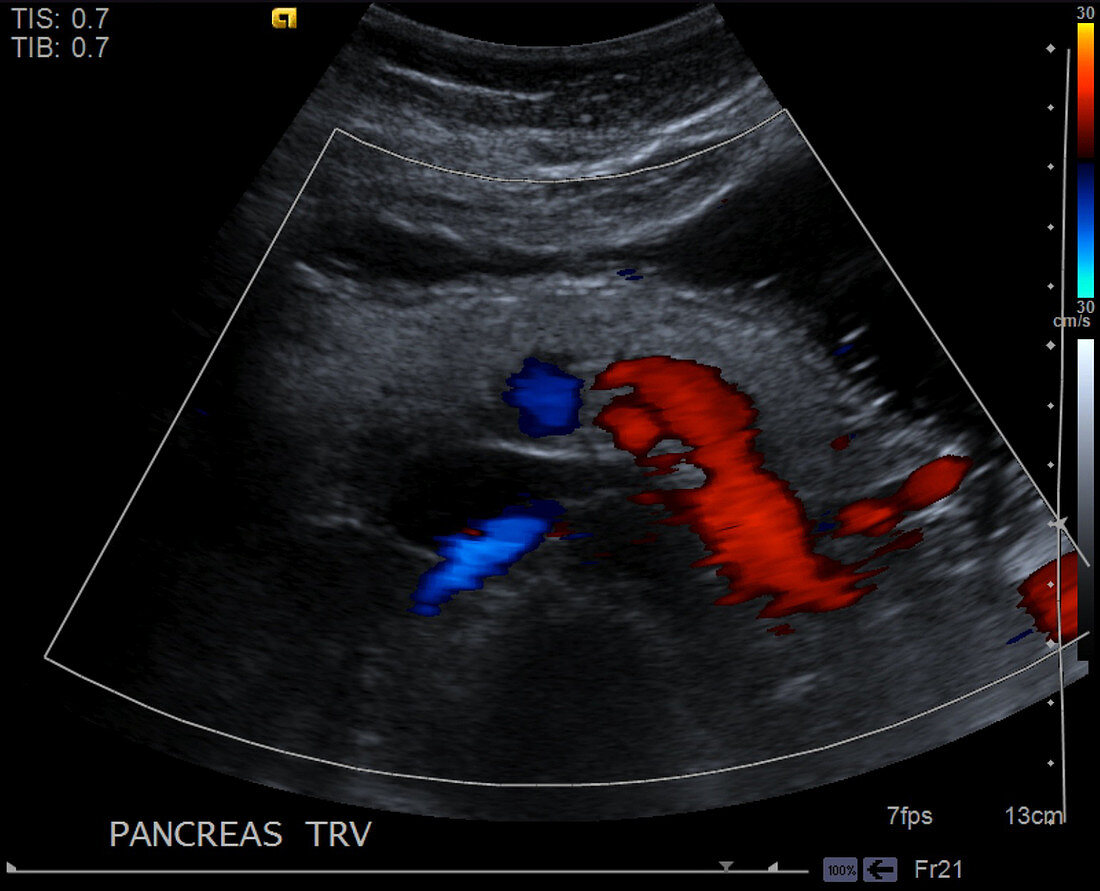 Normal pancreas, ultrasound