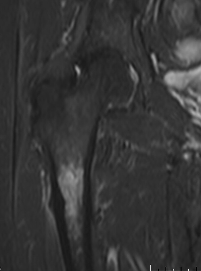 Bisphosphonate femur fracture, MRI