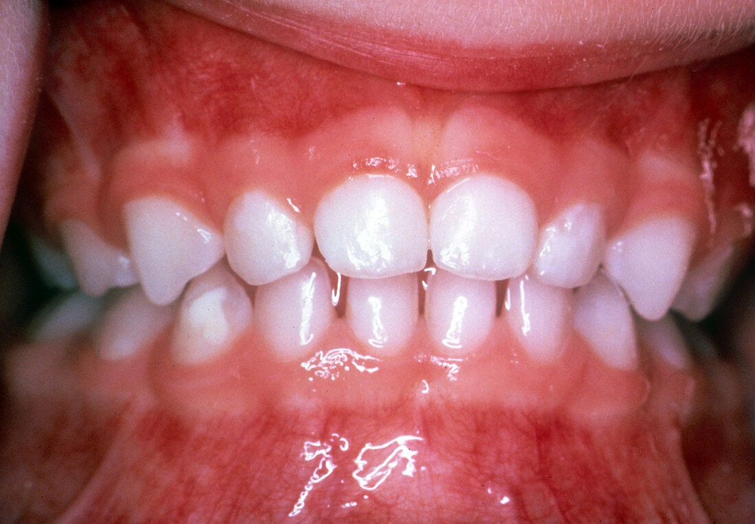Primary Teeth Full Set, 3 Year Old