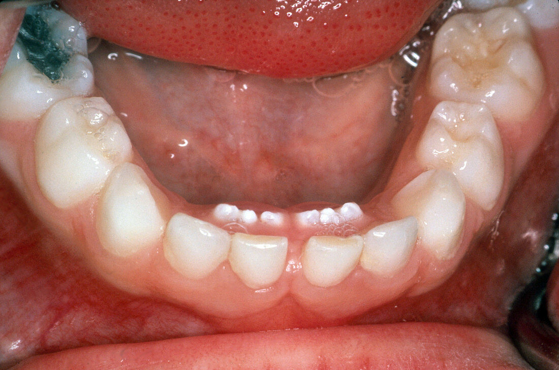 Permanent Teeth Eruption