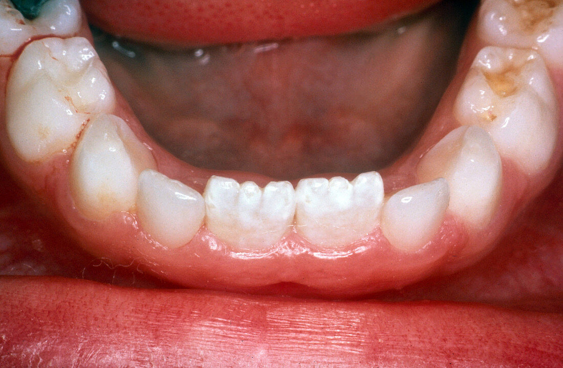 Permanent Teeth, Removed Over-Retained Incisors
