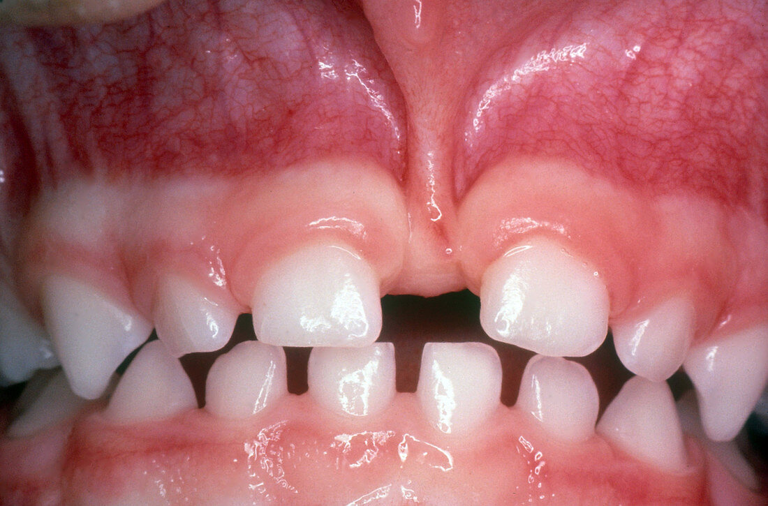 Large Front Gap in Teeth