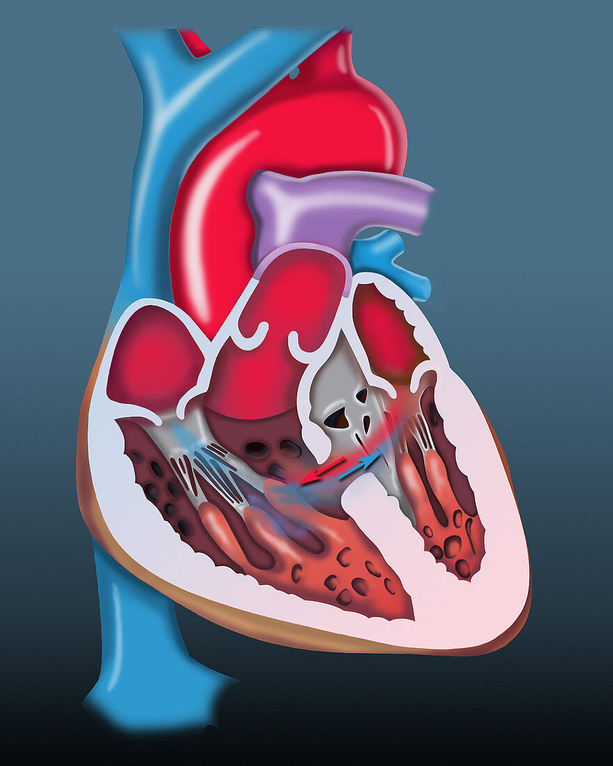 Heart with ventricular septal defect, illustration