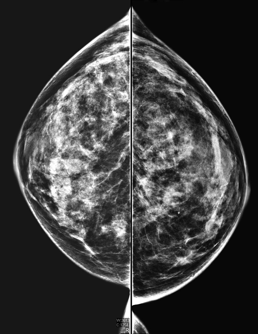 Normal dense mammogram