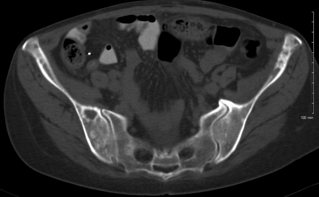 Metastases in hips and pelvis, CT scan