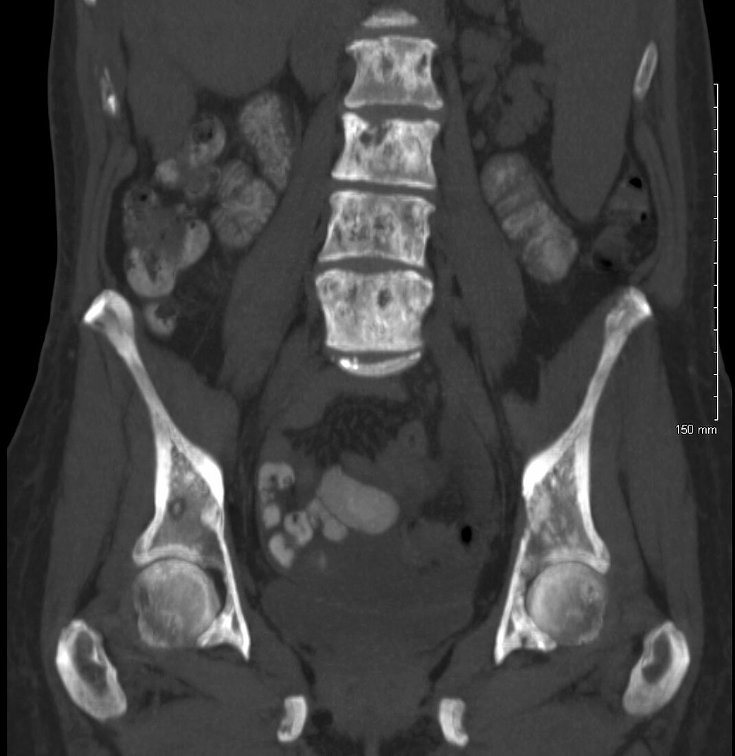 Metastases in hips, pelvis, spine; CT scan