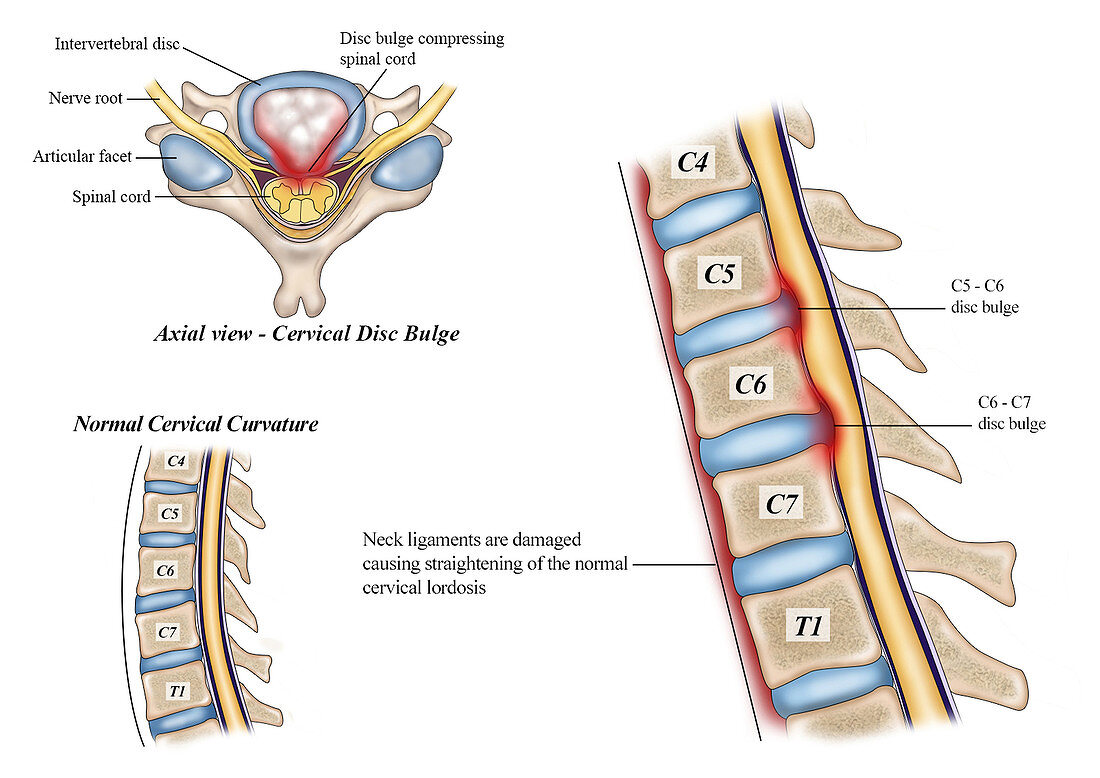 Cervical Lordosis Straightening, illustration