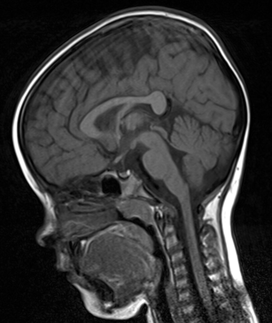Brain of a 5 year old, normal MRI