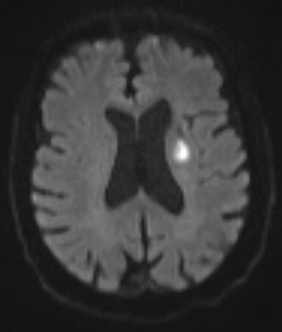 Subacute stroke, MRI