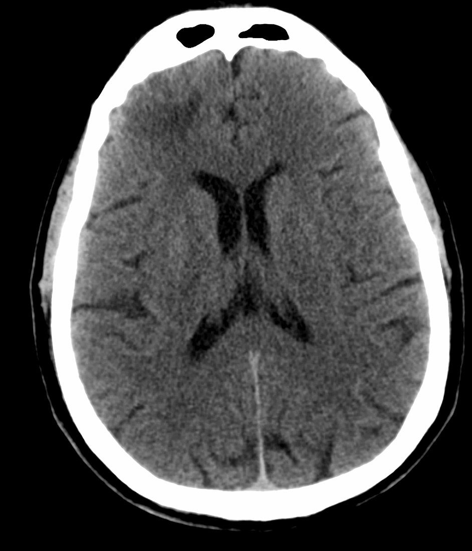 Brain Contusion, CT scan
