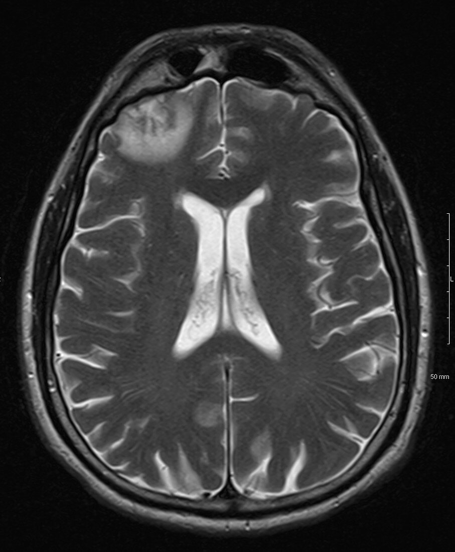 Brain Contusion, MRI