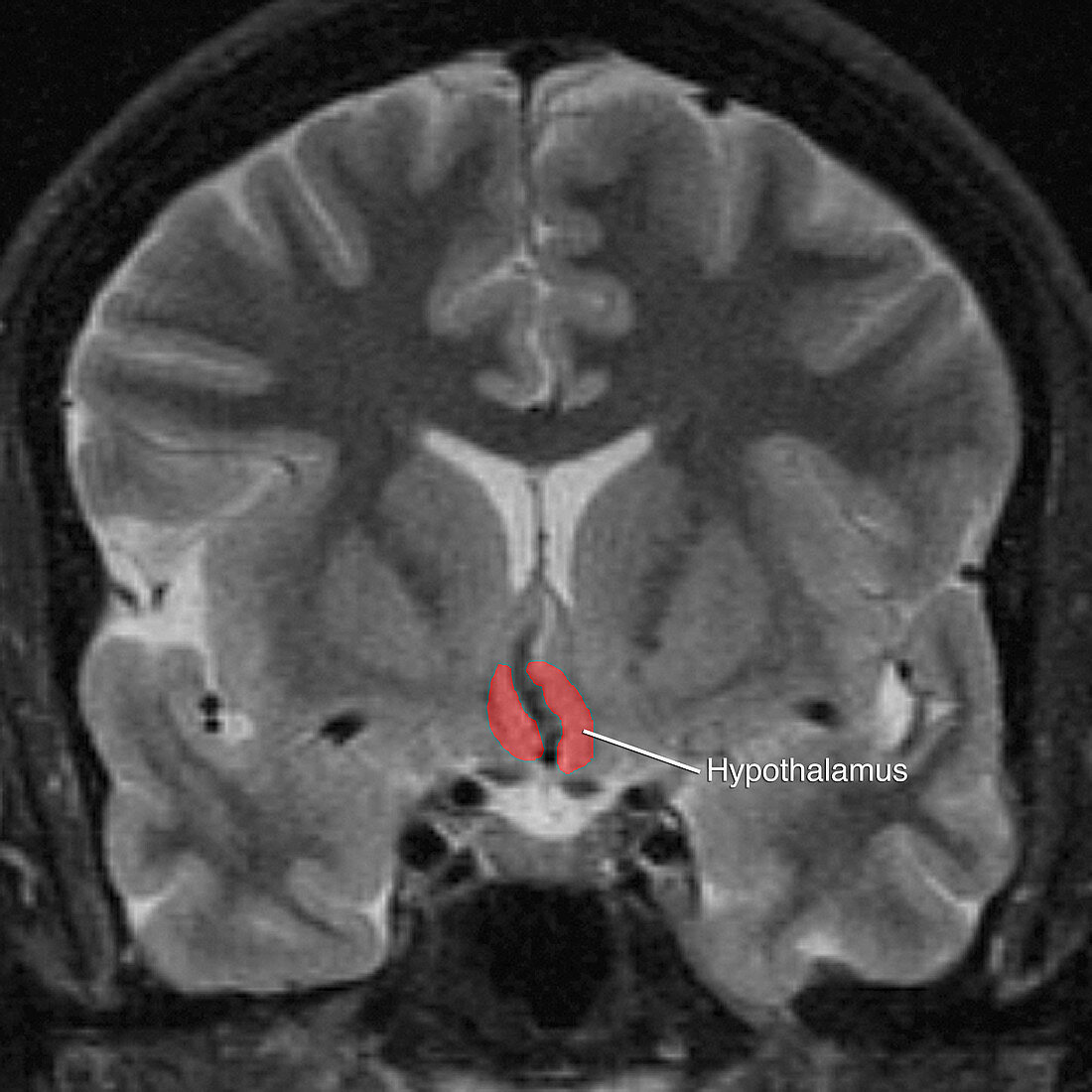 Hypothalamus, MRI