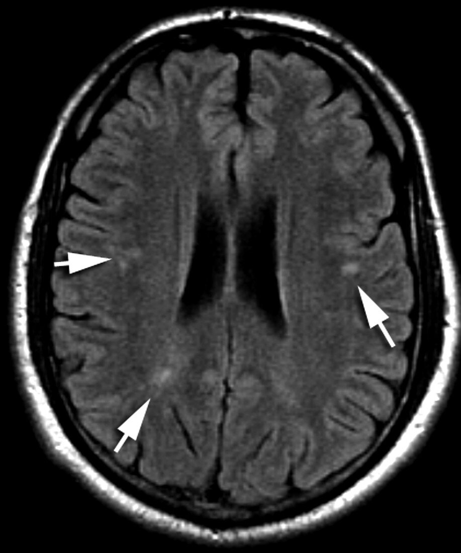 Migraine, MRI