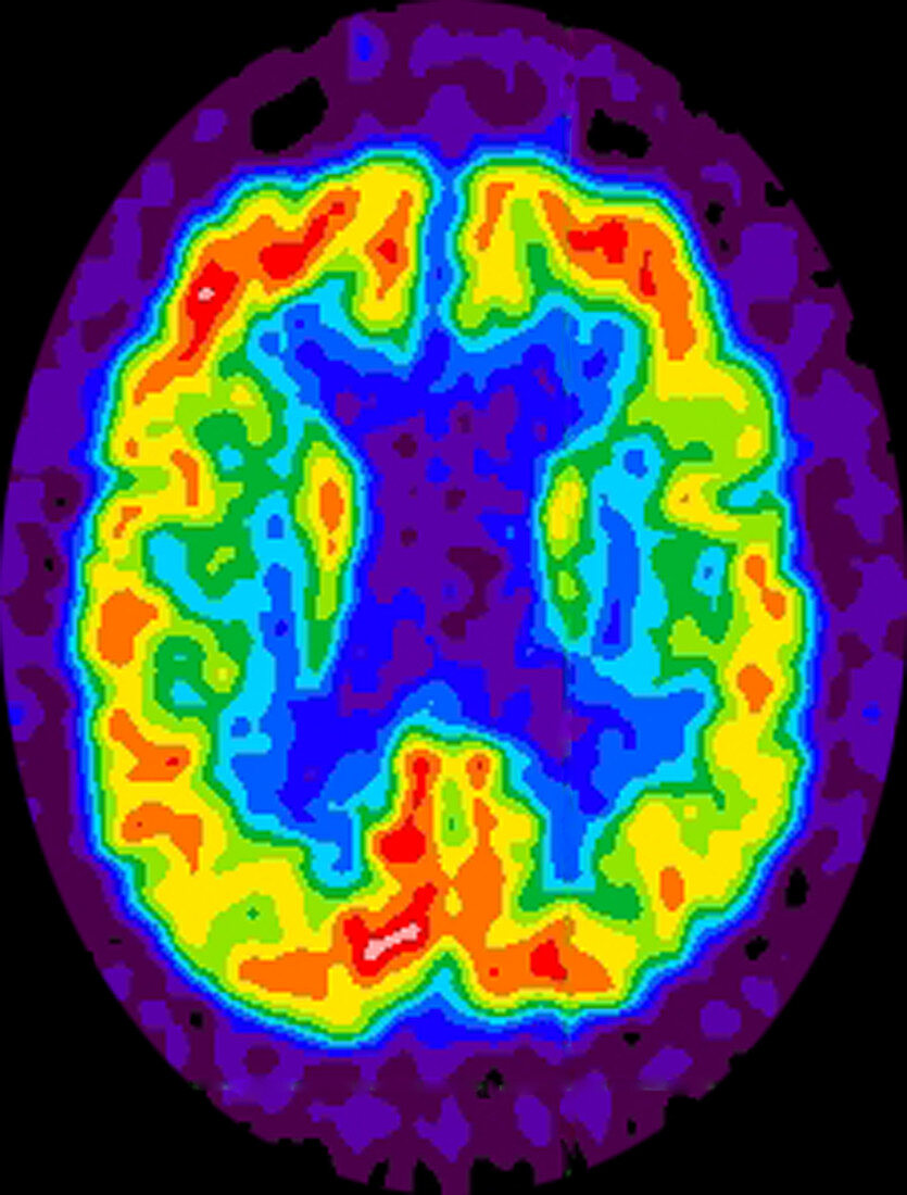 Alzheimer's, PET scan