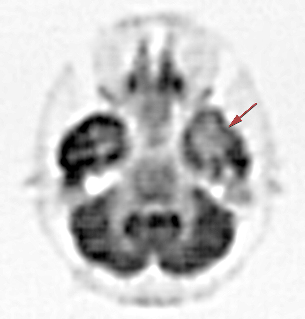 Epilepsy, PET scan