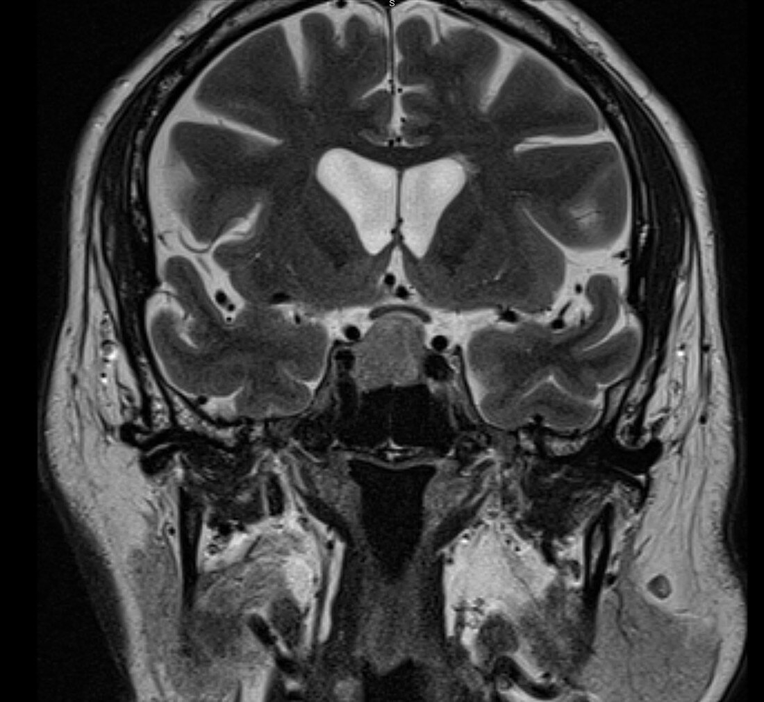 Pituitary macroadenoma, MRI
