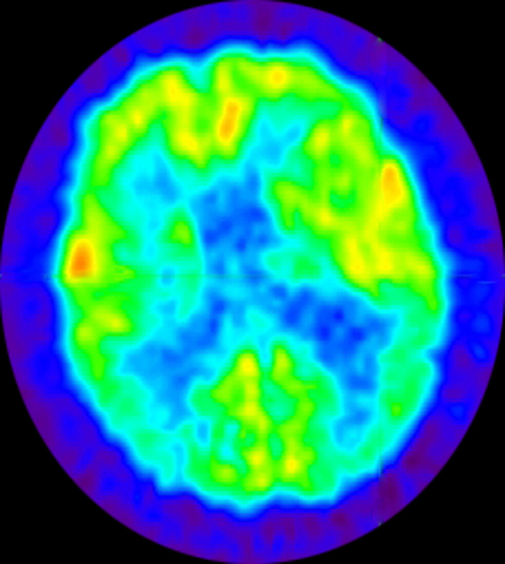Alzheimer's disease, PET scan
