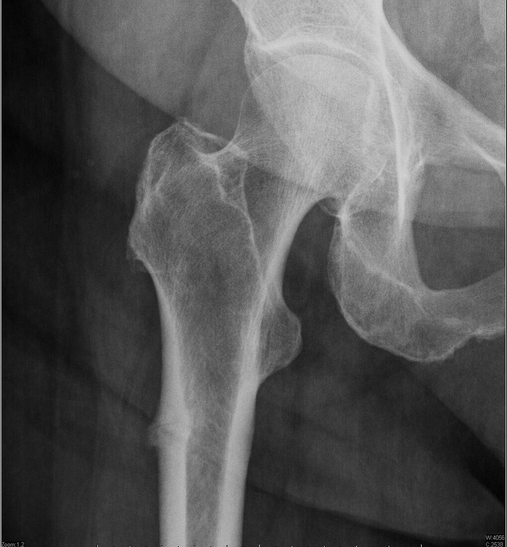 Bisphosphonate femur fracture, X-ray