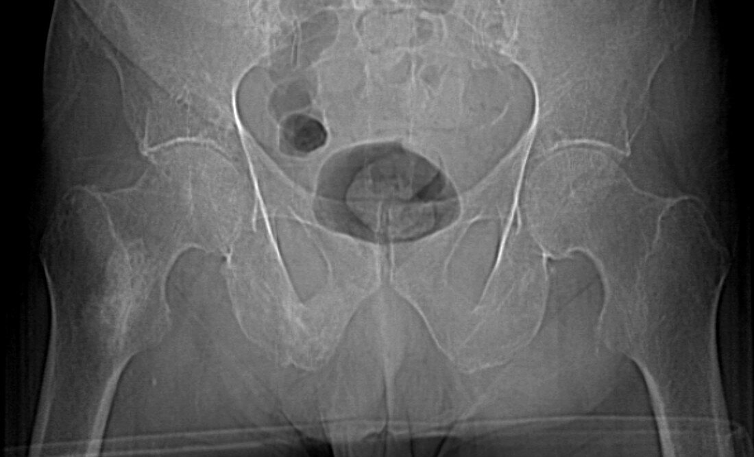 Blastic femur metastases, X-ray