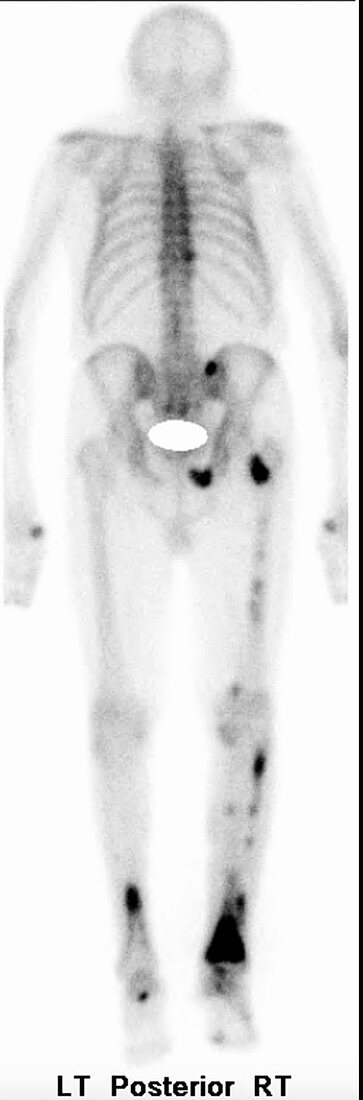 Prostate cancer, bone scintigraphy