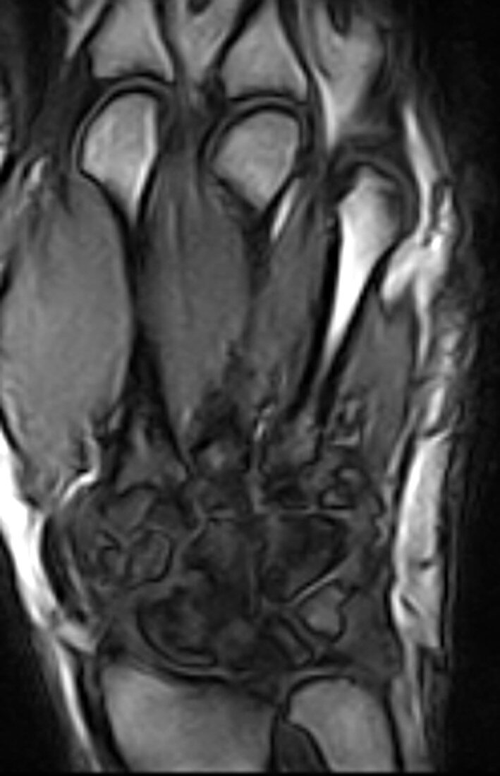 Bone marrow edema osteitis, MRI