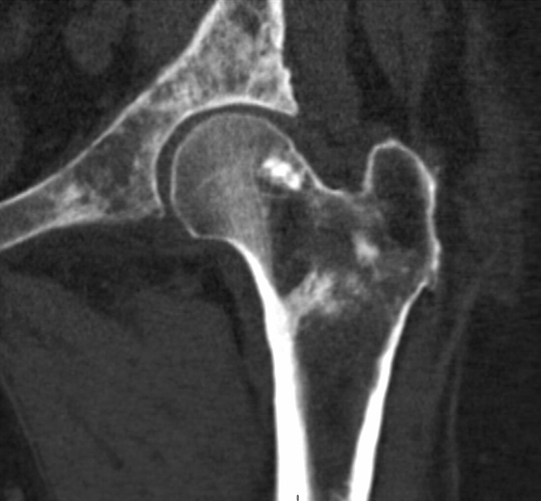 Hip metastases, CT scan