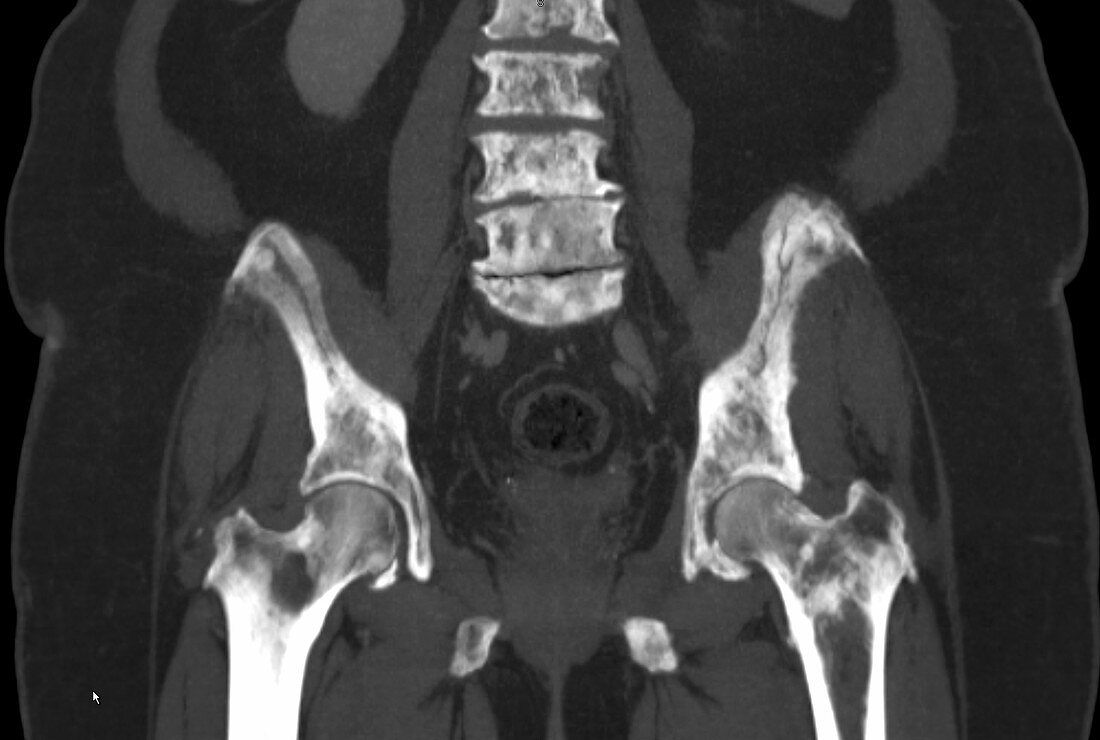 Pelvis metastases, CT scan