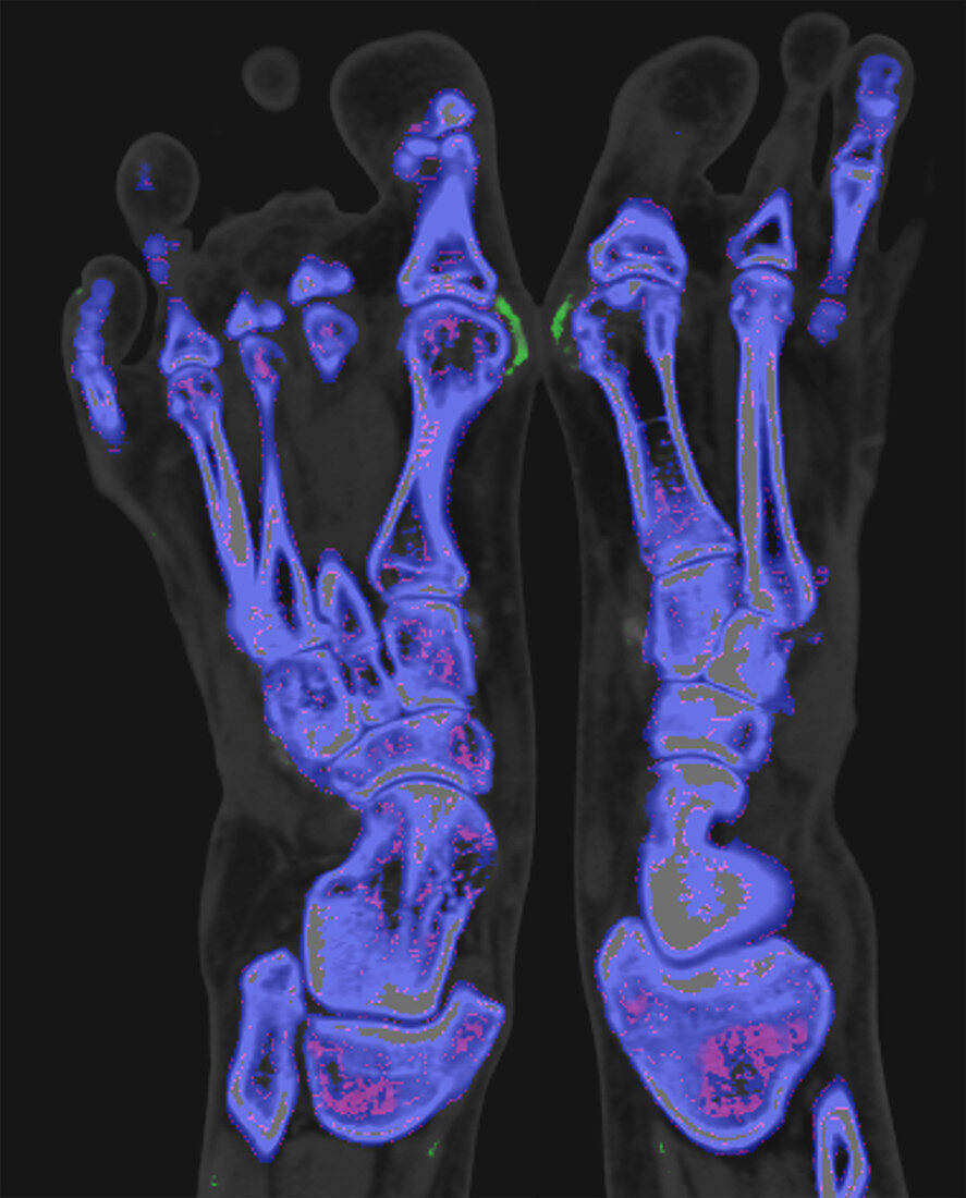 Gout, dual energy CT scan