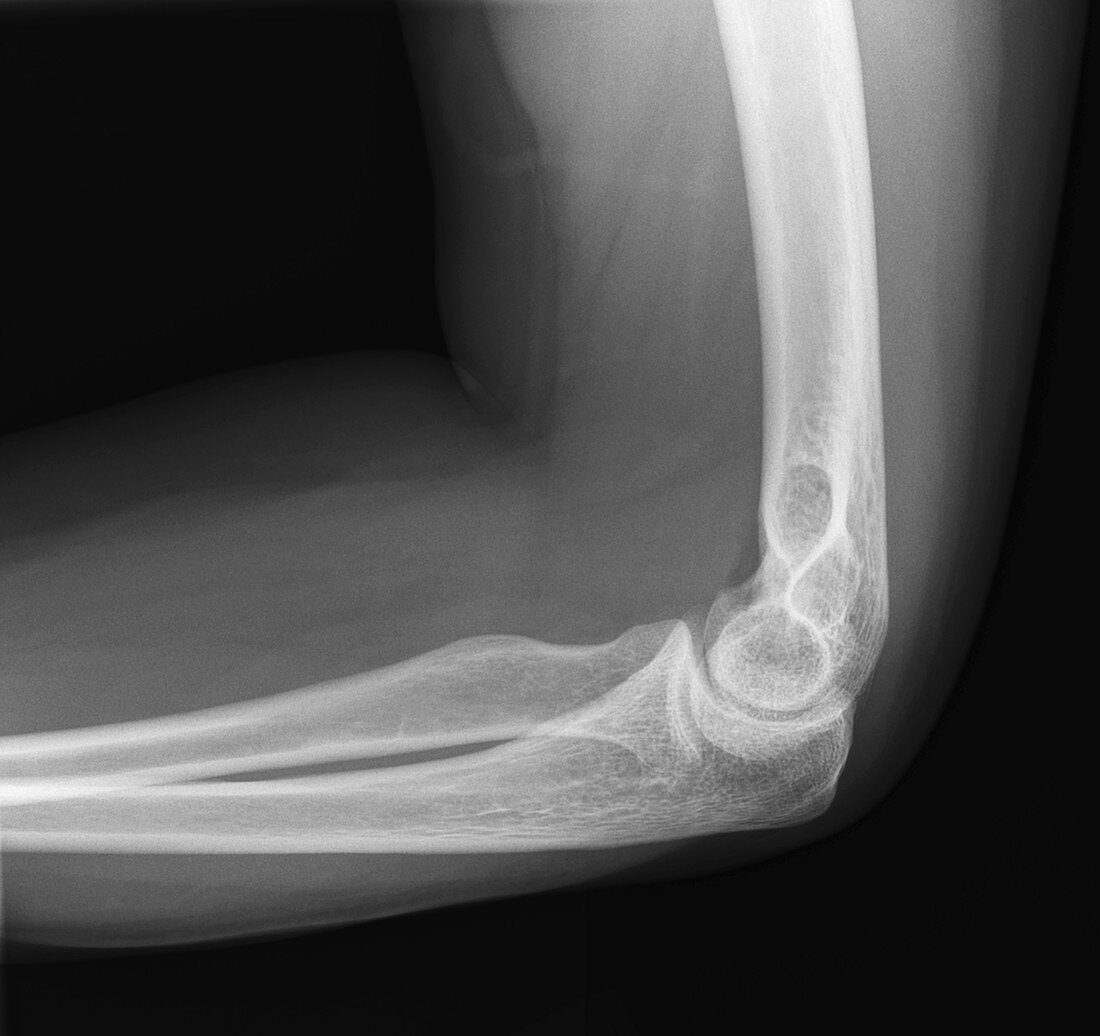 Normal elbow, X-ray