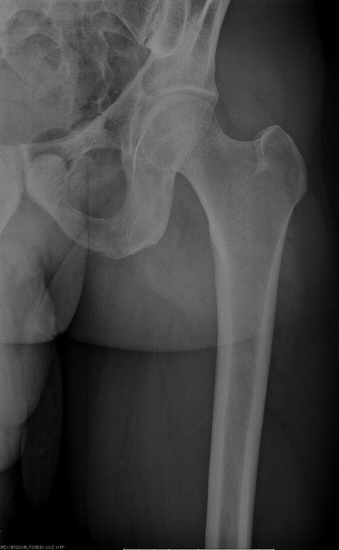 Normal femur, X-ray